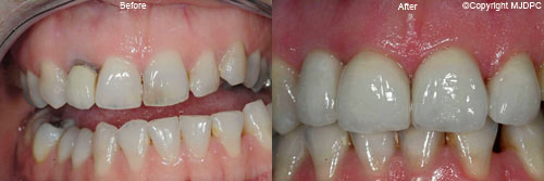 Dental Implants