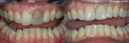 Dental Implants